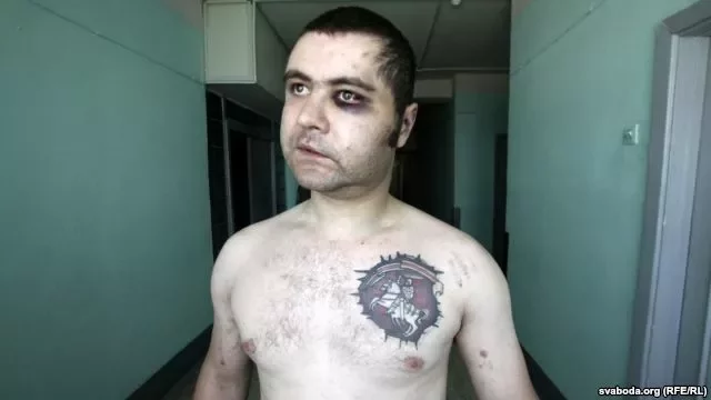 Избитый 19 мая Андрей Молчан.